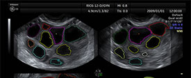 Pelvic-ultrasound